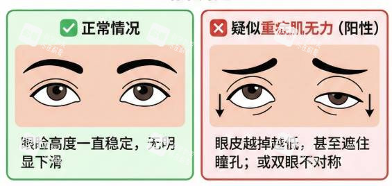 cfs眼肌无力上眼下垂示意图.jpg cfs眼肌无力上眼下垂示意图.jpg
