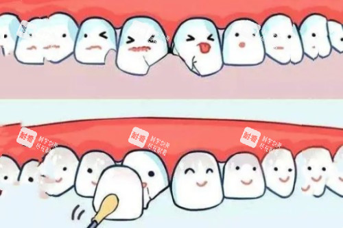 牙贴面卡通图.jpg