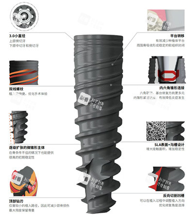 百齿泰泰锆3.0种植牙怎么样.jpg 百齿泰泰锆3.0种植牙怎么样.jpg