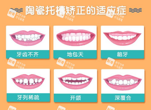 陶瓷半隐形矫正适应症.jpg 陶瓷半隐形矫正适应症.jpg
