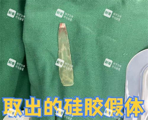 取出的硅胶假体照片.jpg 取出的硅胶假体照片.jpg
