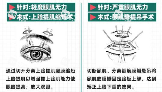 cfs额肌悬吊手术示意图.jpg